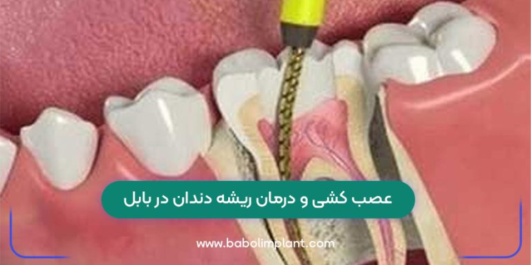 Root canal treatment and root canal treatment in Babylon