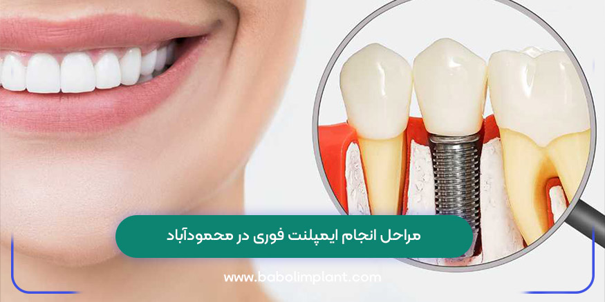 مراحل انجام ایمپلنت فوری در محمودآباد