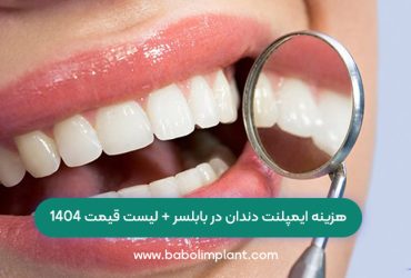 هزینه ایمپلنت دندان در بابلسر + لیست قیمت 1404