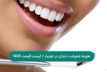 هزینه ایمپلنت دندان در جویبار + لیست قیمت 1404