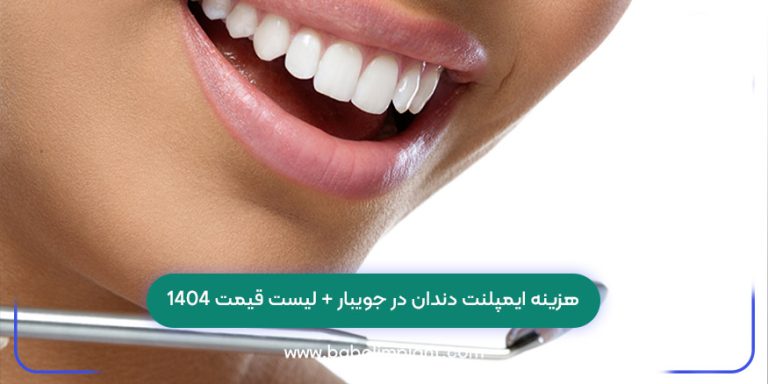 هزینه ایمپلنت دندان در جویبار + لیست قیمت 1404