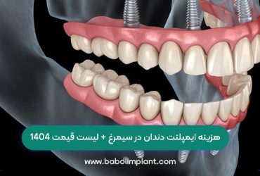 هزینه ایمپلنت دندان در سیمرغ + لیست قیمت 1404