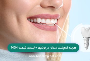 هزینه ایمپلنت دندان در نوشهر