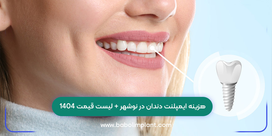 هزینه ایمپلنت دندان در نوشهر
