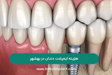 هزینه ایمپلنت دندان در بهشهر