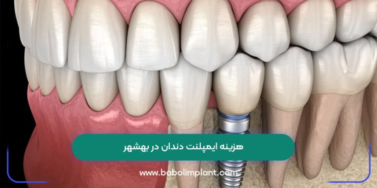 هزینه ایمپلنت دندان در بهشهر