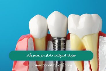 هزینه ایمپلنت دندان در عباس‌آباد