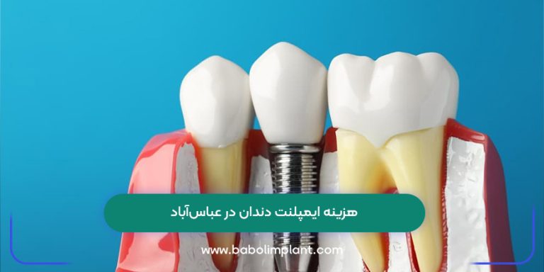 هزینه ایمپلنت دندان در عباس‌آباد