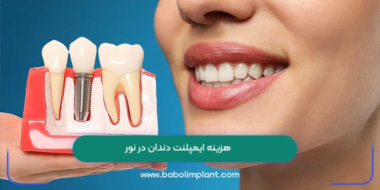 هزینه ایمپلنت دندان در نور