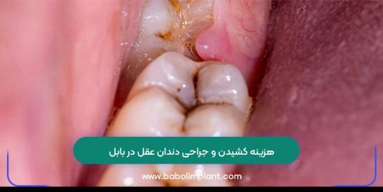 هزینه کشیدن و جراحی دندان عقل در بابل