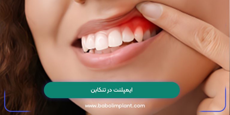 ایمپلنت در تنکابن