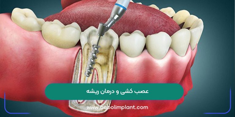 عصب کشی و درمان ریشه