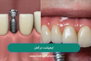 ایمپلنت در آمل