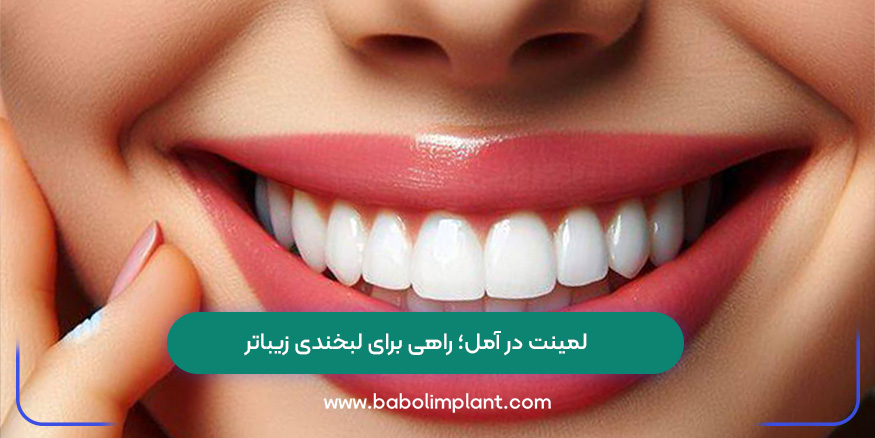 لمینت در آمل؛ راهی برای لبخندی زیباتر