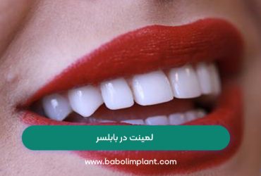 لمینت در بابلسر