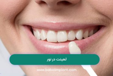لمینت در نور
