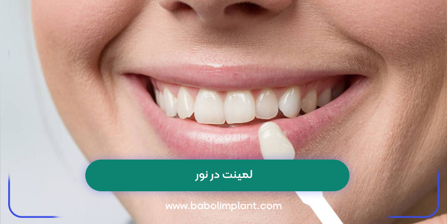 لمینت در نور