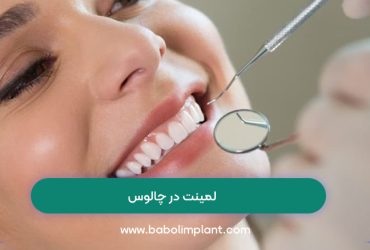 لمینت در چالوس