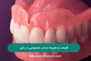 قیمت و هزینه دندان مصنوعی در بابل