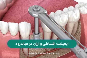 Cheap and installment implants in Meanderod