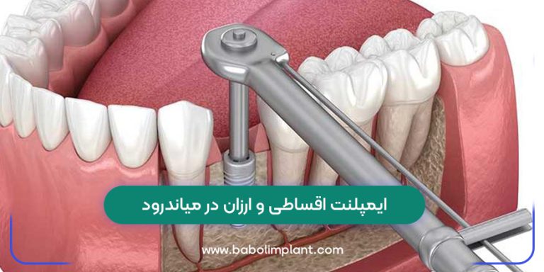 Cheap and installment implants in Meanderod