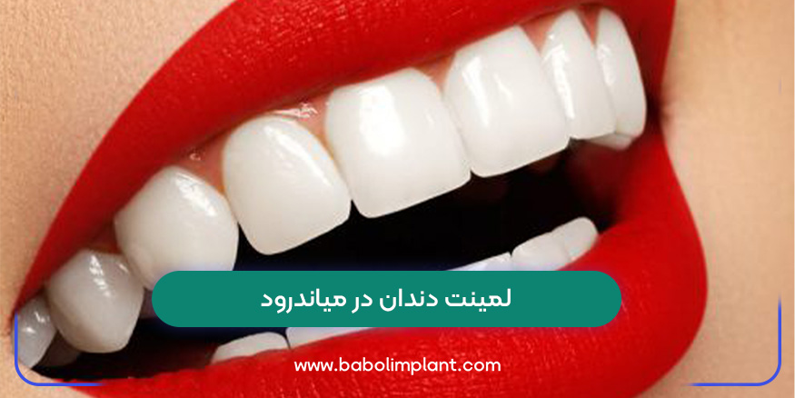 Dental laminate in Meanderod