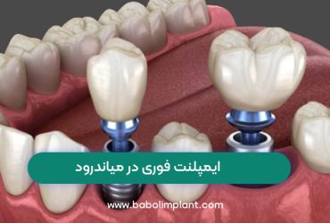 Immediate implants in Meanderod