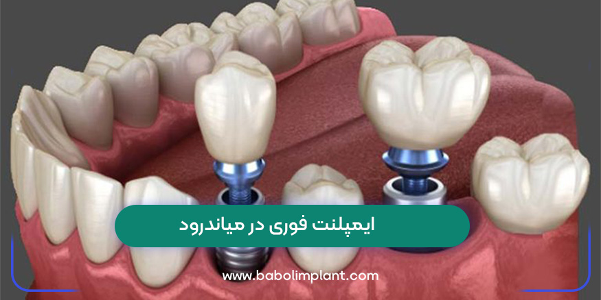 Immediate implants in Meanderod