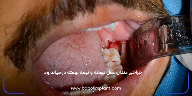 Impacted and semi-impacted wisdom tooth surgery in Meanderod