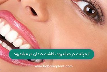 Implants in Meanderod, dental implants in Meanderod