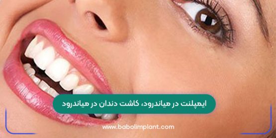 Implants in Meanderod, dental implants in Meanderod