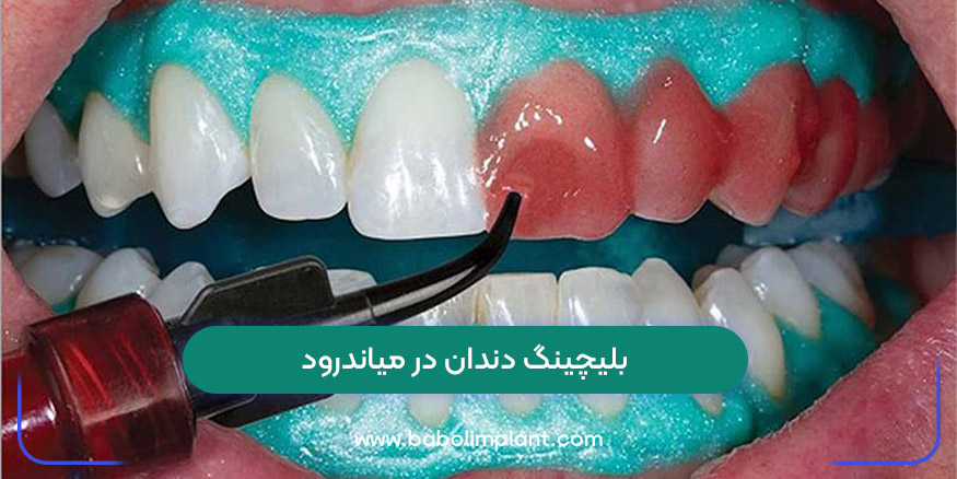 Teeth bleaching in Meanderod