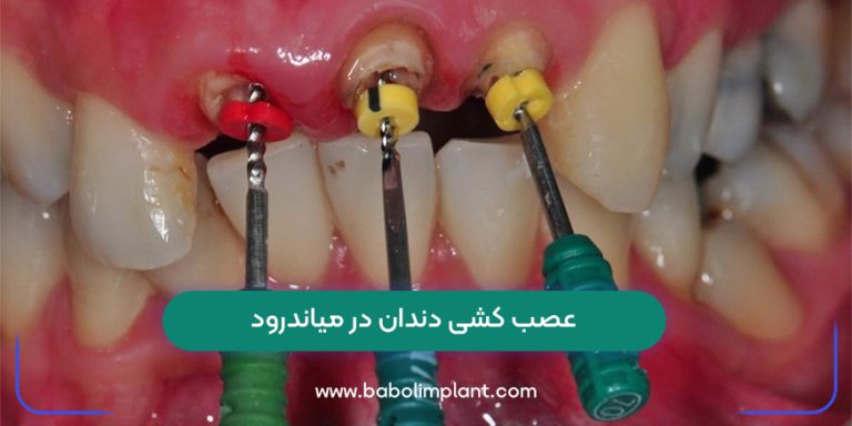 Tooth extraction in Meanderod