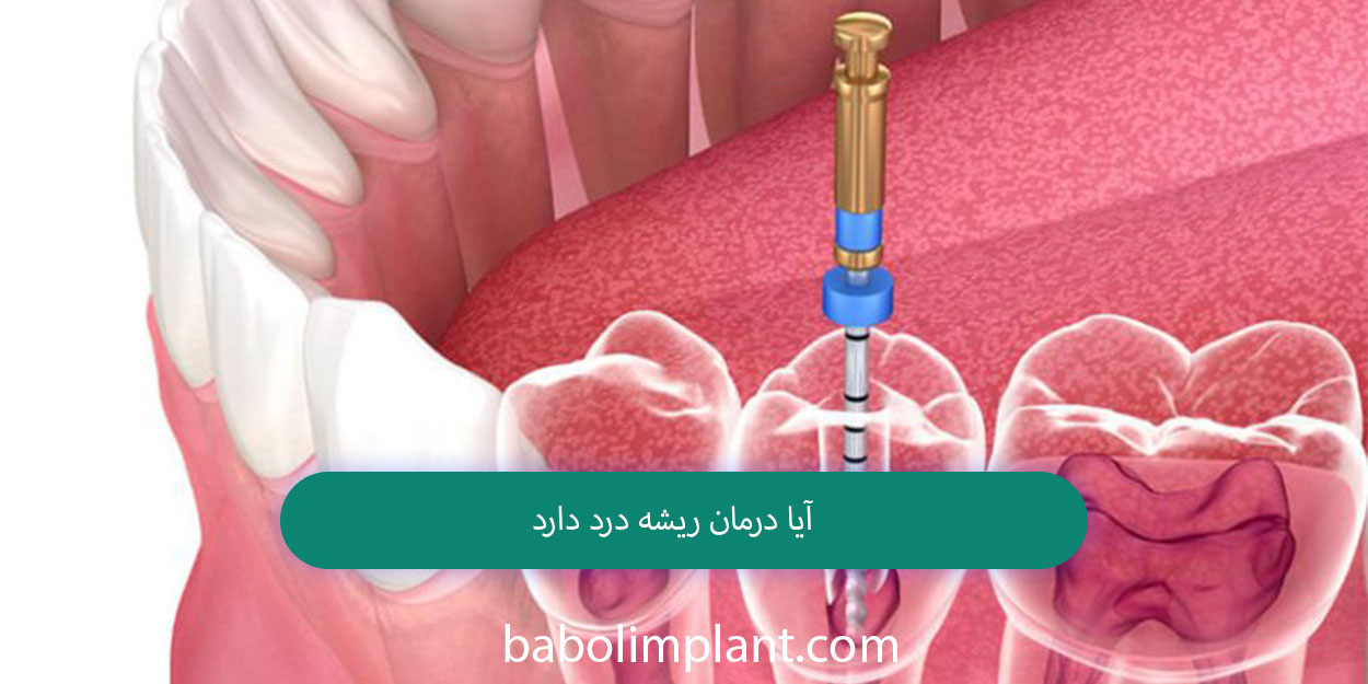 Does root canal treatment hurt?