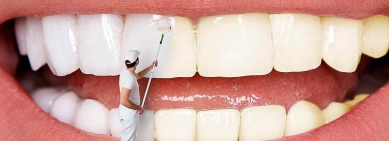 مراقبت های بعد بلیچینگ دندان