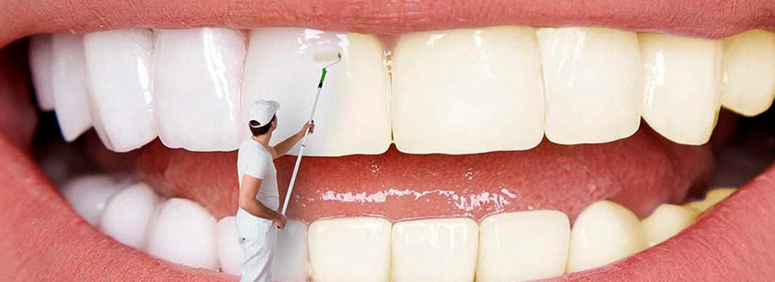 مراقبت های بعد بلیچینگ دندان