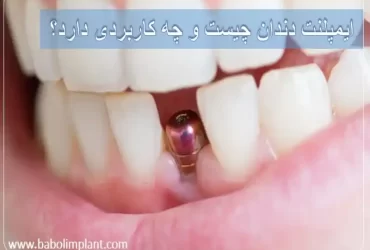 ایمپلنت دندان چیست و چه کاربردی دارد؟