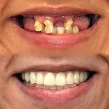 عکس از نمونه کار دندانپزشکی در بابل