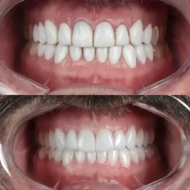 اهمیت کامپوزیت دندان