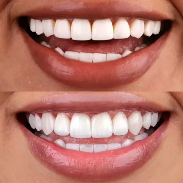 کامپوزیت دندان در مازندران: راهی برای لبخندی زیبا و درخشان