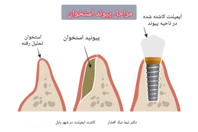 پیوند استخوان در دندانپزشکی