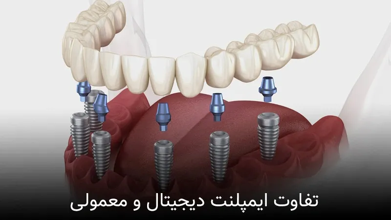 تفاوت ایمپلنت دیجیتال و معمولی