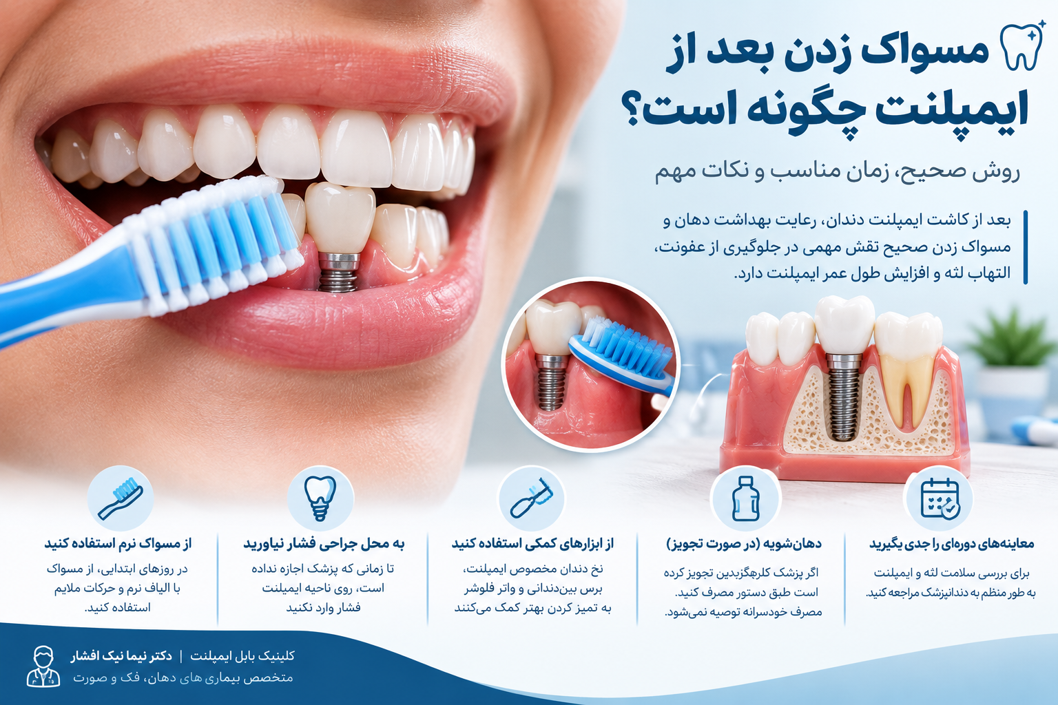 مسواک زدن بعد از ایمپلنت چگونه است