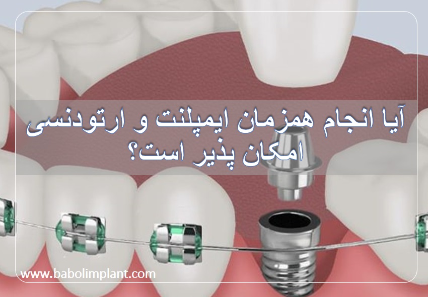 آیا انجام همزمان ایمپلنت و ارتودنسی امکان پذیر است؟