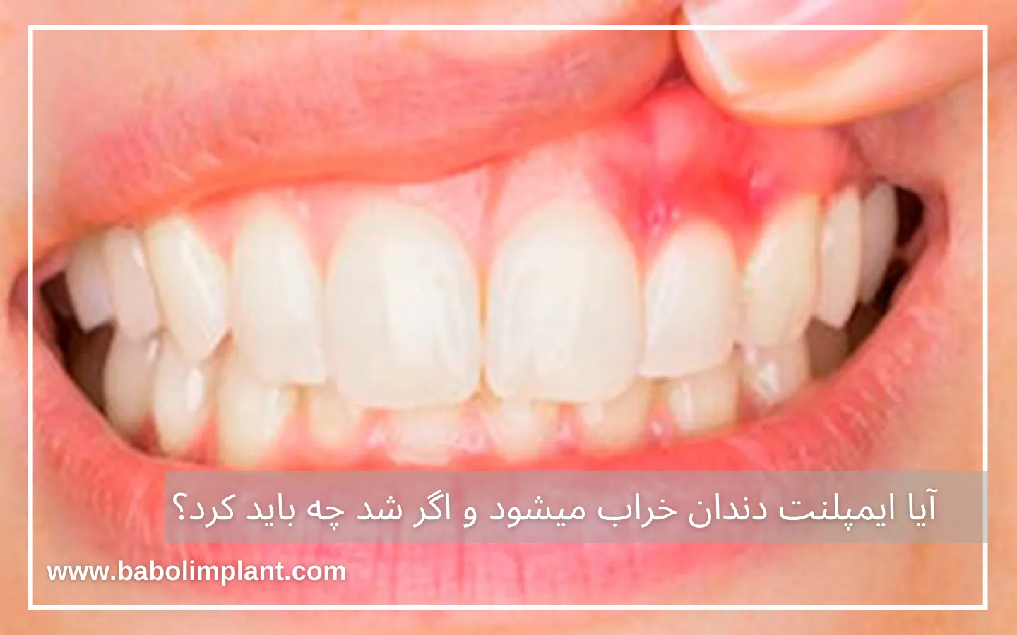 آیا ایمپلنت دندان خراب میشود و اگر شد چه باید کرد؟ (2)