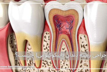 جراحی ریشه دندان (اپیکوکتومی) چیست؟