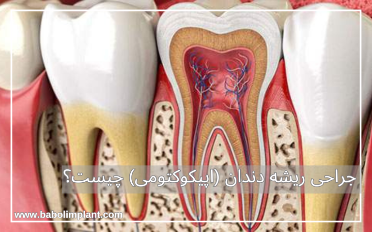 جراحی ریشه دندان (اپیکوکتومی) چیست؟