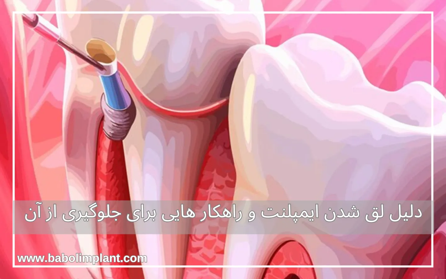 دلیل لق شدن ایمپلنت و راهکار هایی برای جلوگیری از آن