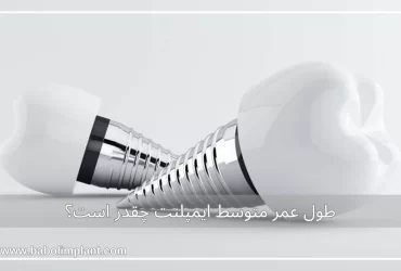 طول عمر متوسط ایمپلنت چقدر است؟