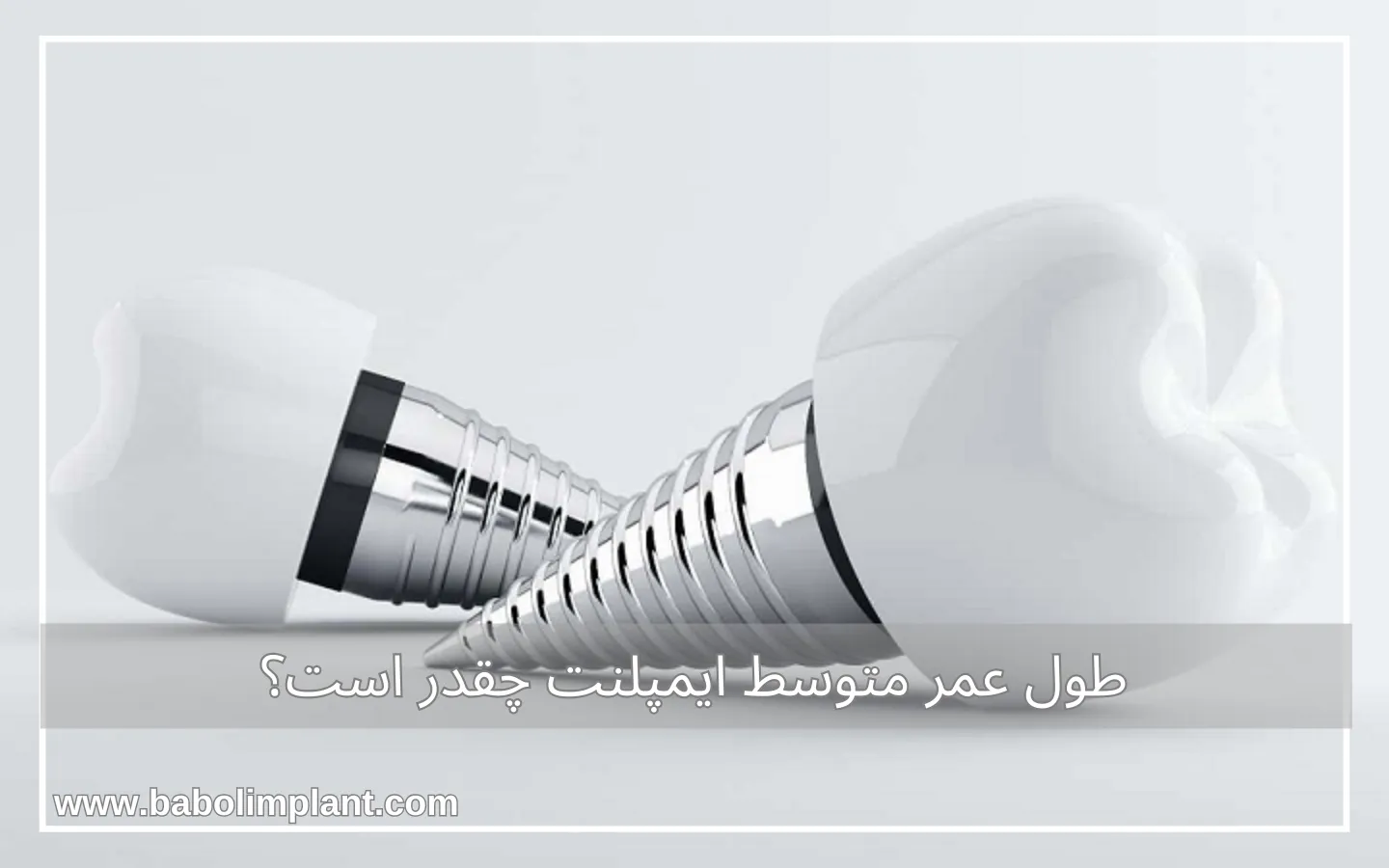 طول عمر متوسط ایمپلنت چقدر است؟